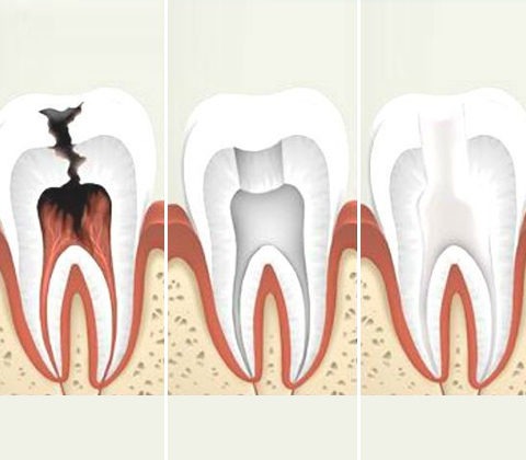 Удаление нерва в зубе в Доступной Стоматологии