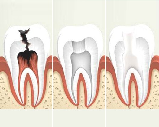 Удаление нерва в зубе в Доступной Стоматологии