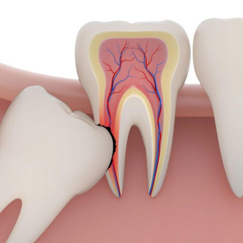 Удаление зуба мудрости в Доступной Стоматологии