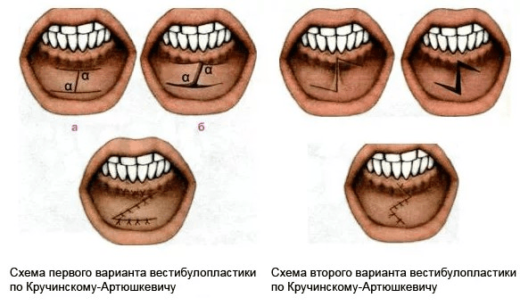Методы вестибулопластики в стоматологии