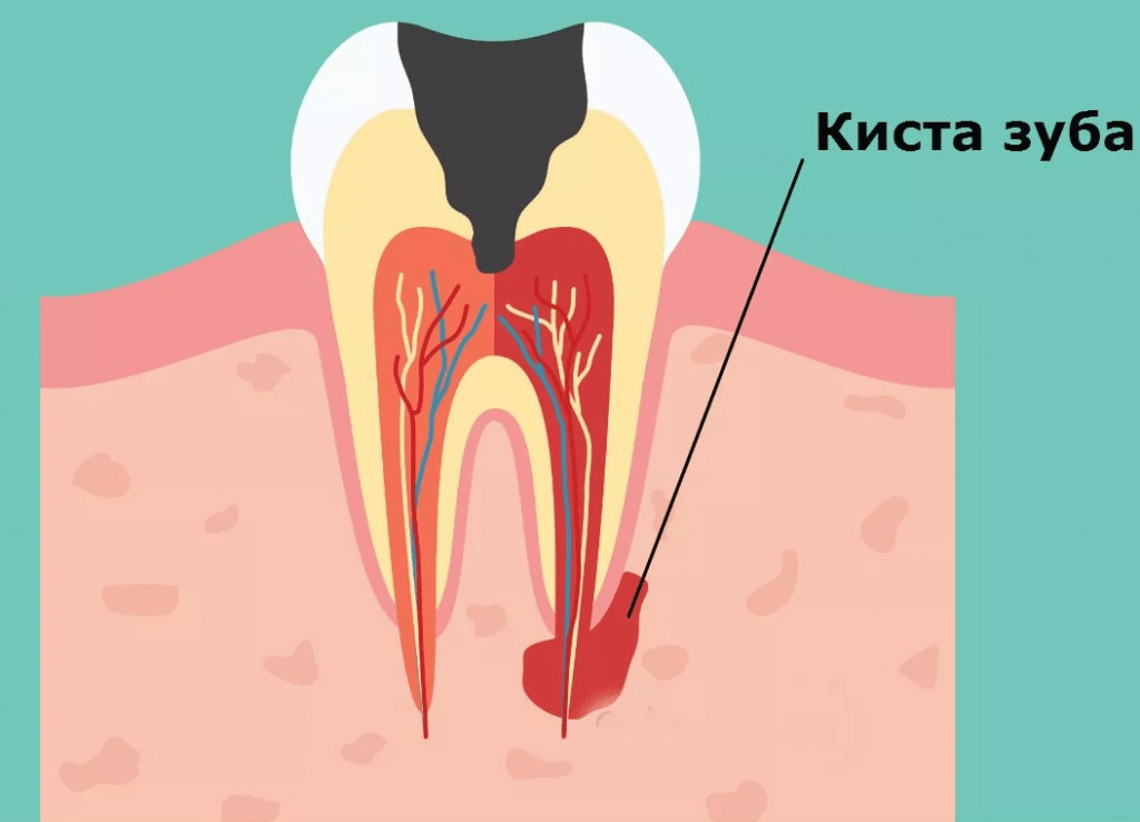 Что такое киста зуба