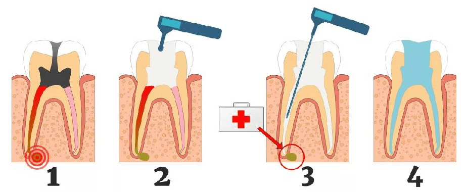 Удаление кисты с сохранением зуба