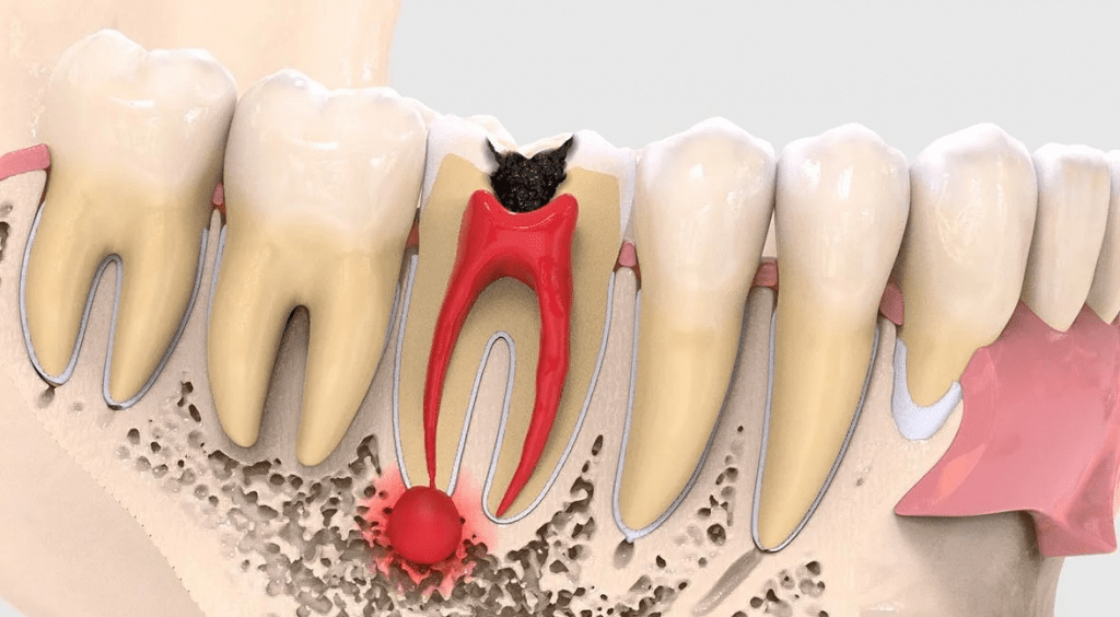 Особенности удаления кисты верхних и нижних зубов