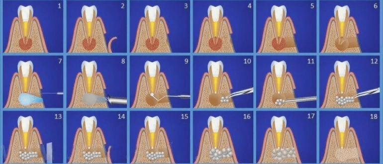 Этапы резекции верхушки зуба