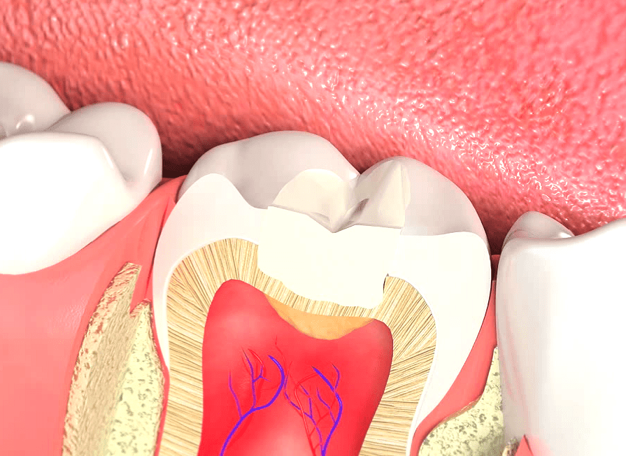 Сколько стоит лечение каналов зуба и пломбирование