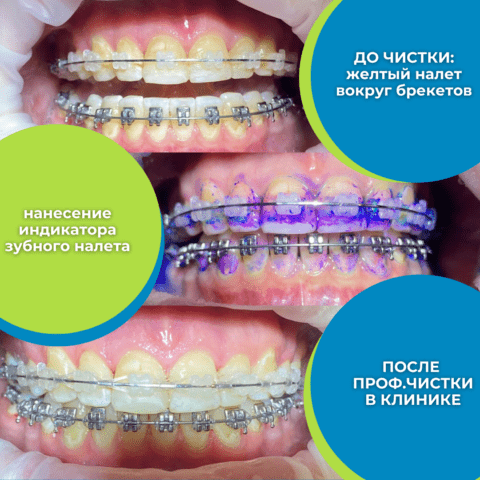 Доступная Стоматология. Нанесение индикатора зубного налета