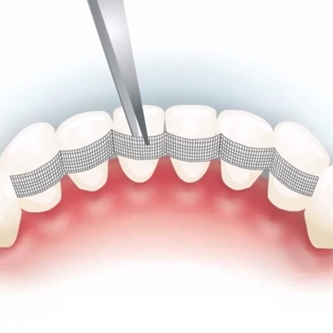 Шинирование зубов в доступной Стоматологии