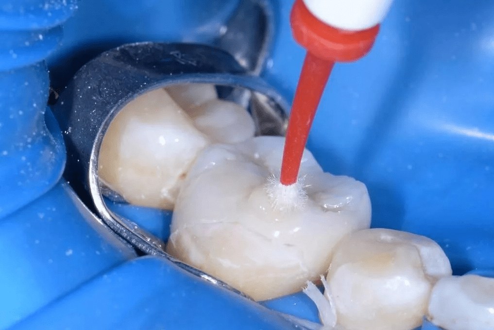 Методы восстановления сложных зубов