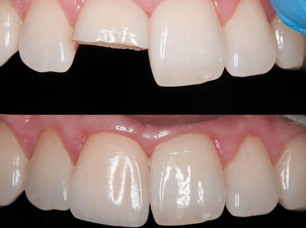 Наращивание зубов в Доступной Стоматологии
