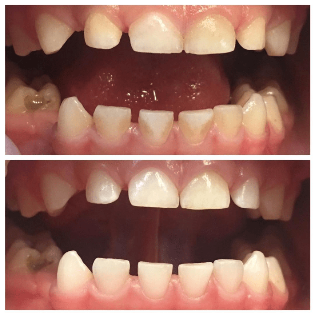 Профессиональная чистка зубов в Доступной Стоматологии