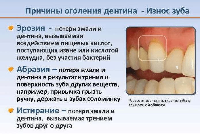 Причина оголения дентина - Износ зуба