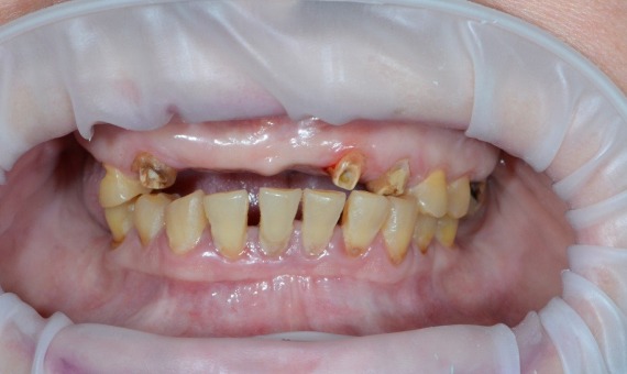 Протезирование зубов All-on-4 за один день. До лечения