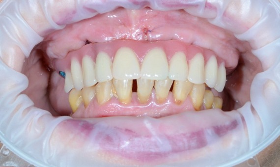 Протезирование зубов All-on-4 за один день. После лечения