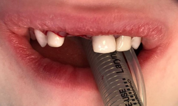 Лечение молочных зубов. После лечения