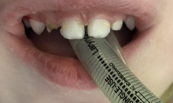 Лечение молочных зубов под наркозом. Фото 1