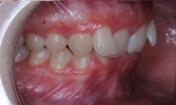 Ортодонтическое лечение на брекет-системах. До лечения
