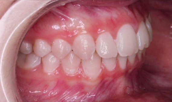 Ортодонтическое лечение на брекет-системах. После лечения
