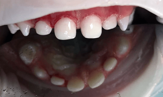 Лечение молочных зубов. Фото 2
