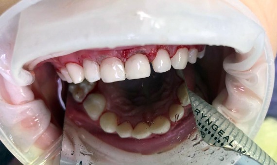 Лечение зубов под наркозом. Фото 2